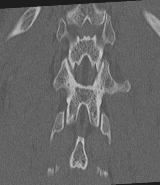 File:Acute L1 burst compression fracture (Radiopaedia 34430-35755 Coronal bone window 47).png