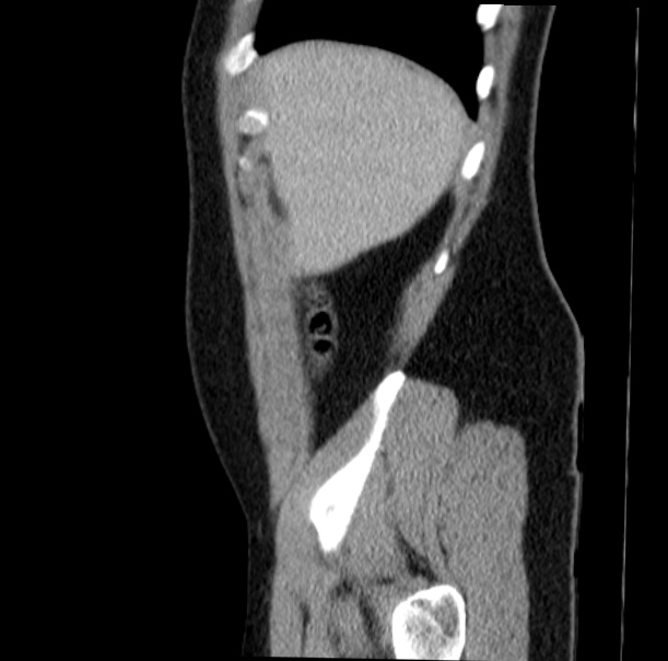 Acute appendicitis (Radiopaedia 38255-40270 Sagittal C+ portal venous phase 12).jpg