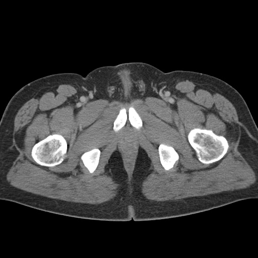 Acute appendicitis (Radiopaedia 48511-53463 Axial C+ portal venous phase 106).jpg