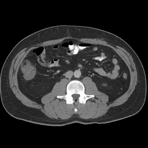 Acute appendicitis (Radiopaedia 48511-53463 Axial C+ portal venous phase 52).jpg