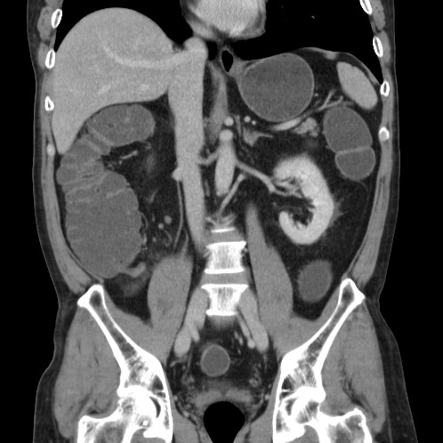 File:Acute appendicitis (Radiopaedia 66513-75790 Coronal C+ portal venous phase 45).jpg