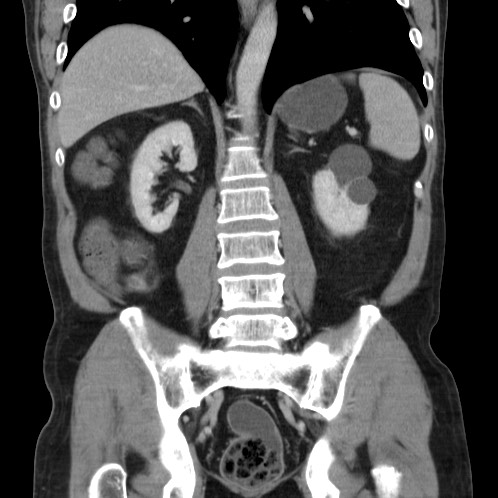 Acute appendicitis (Radiopaedia 66513-75790 Coronal C+ portal venous phase 58).jpg