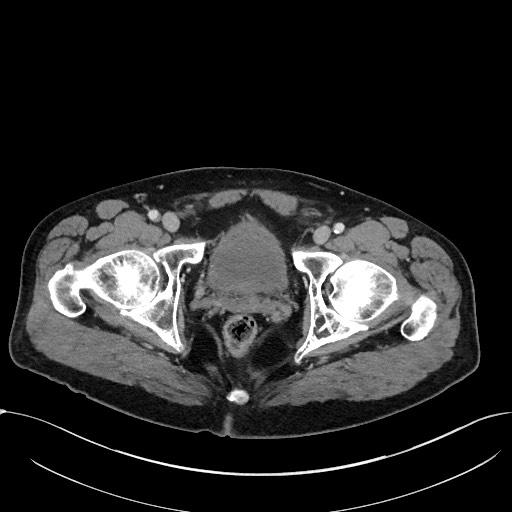 Acute appendicitis - large appendicoliths (Radiopaedia 61805-69820 Axial C+ portal venous phase 126).jpg
