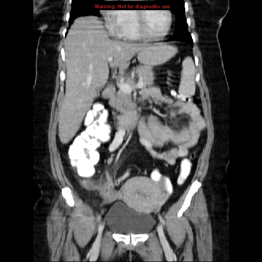 File:Acute appendicitis complicated by ovarian vein thrombophlebitis (Radiopaedia 16172-15851 Coronal C+ portal venous phase 36).jpg