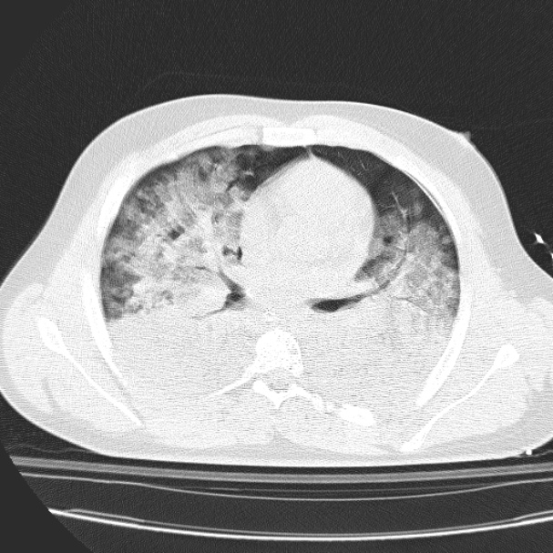 Acute aspiration pneumonitis (Radiopaedia 33605-34703 Axial lung window 49).jpg