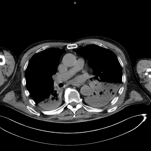 Acute aspiration pneumonitis (Radiopaedia 55642-62166 Axial liver window 32).jpg