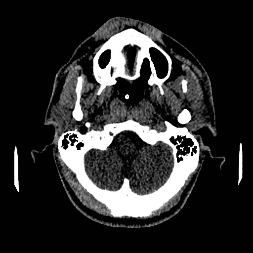 Acute basilar artery occlusion (Radiopaedia 43582-46985 Axial non-contrast 35).jpg