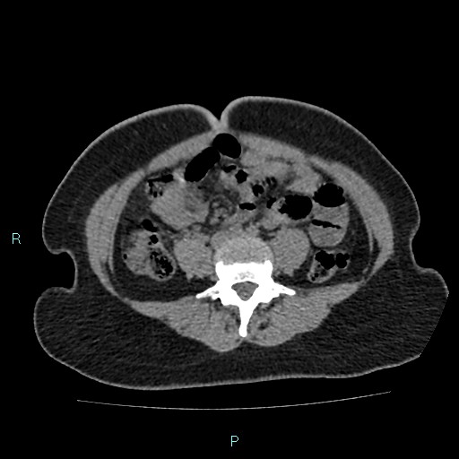 Acute bilateral pyelonephritis (Radiopaedia 37146-38881 Axial non-contrast 67).jpg