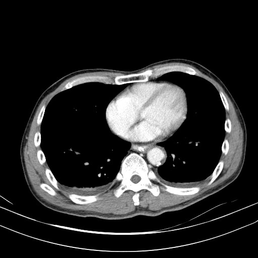 Acute bowel ischemia (Radiopaedia 87695-104114 Axial C+ portal venous phase 5).jpg