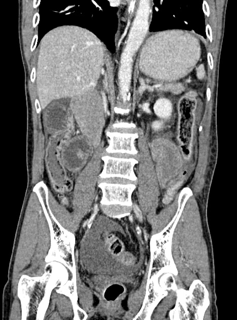 Acute bowel ischemia (Radiopaedia 87695-104114 Coronal C+ portal venous phase 235).jpg