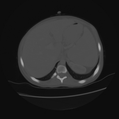 File:Acute calculous cholecystitis in patient with osteopetrosis (Radiopaedia 77871-90159 Axial bone window 11).jpg