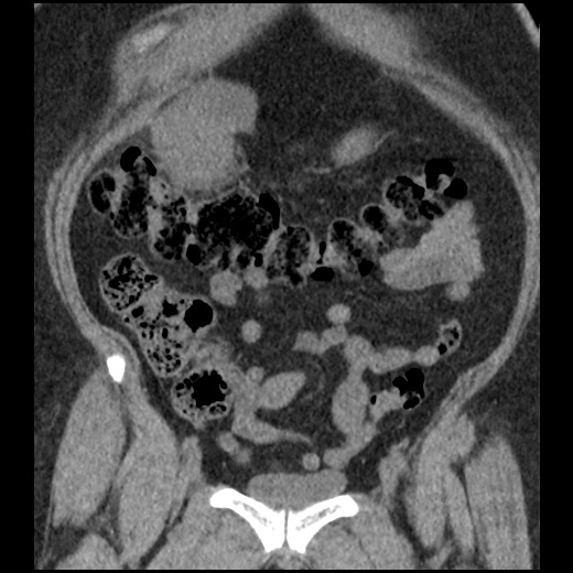 Acute cholecystitis and ureteric colic (Radiopaedia 42330-45444 Coronal prone 33).jpg