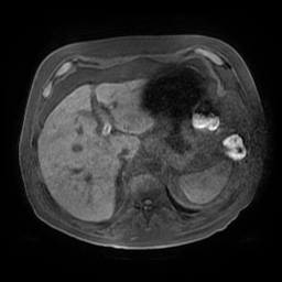 Acute cholecystitis complicated by pylephlebitis (Radiopaedia 65782-74915 Axial T1 fat sat 29).jpg