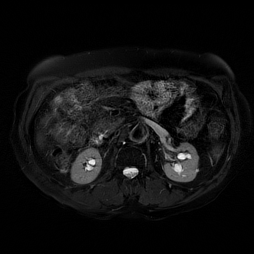 File:Acute cholecystitis complicated by pylephlebitis (Radiopaedia 65782-74915 Axial T2 fat sat 29).jpg