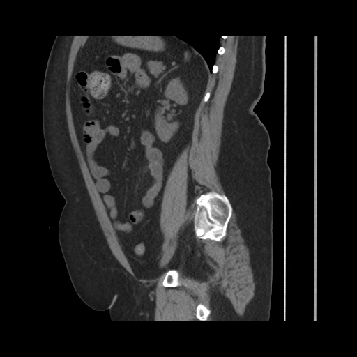 Acute cholecystitis with tensile fundus sign (Radiopaedia 71394-81723 Sagittal non-contrast 110).jpg
