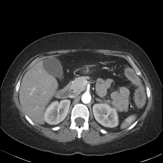 Acute colonic hemorrhage in ulcerative colitis (Radiopaedia 77415-89538 Axial C+ arterial phase 41).jpg
