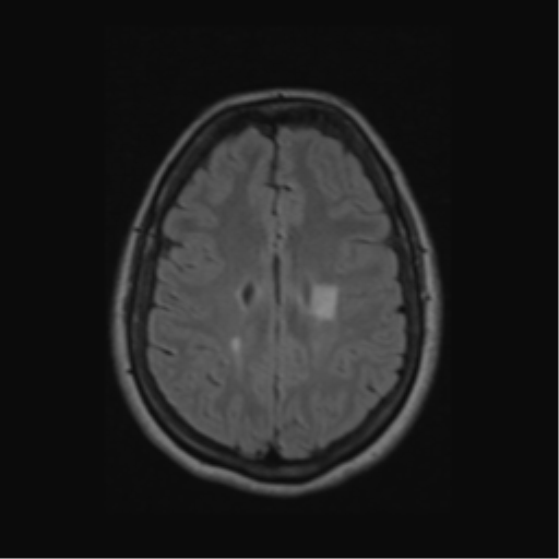 Acute disseminated encephalomyelitis (ADEM) (Radiopaedia 38073-40065 Axial FLAIR 46).png