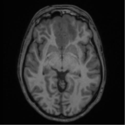 Acute disseminated encephalomyelitis (ADEM) (Radiopaedia 65319-74349 Axial T1 28).png