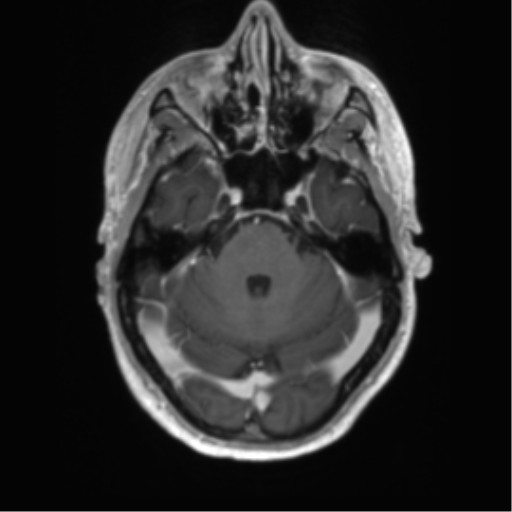 Acute disseminated encephalomyelitis (ADEM) (Radiopaedia 65319-74350 Axial T1 C+ 13).png