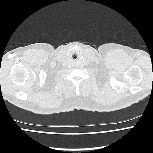 File:Acute epicardial fat necrosis (Radiopaedia 42327-45440 Axial lung window 2).jpg