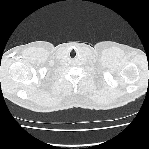 Acute epicardial fat necrosis (Radiopaedia 42327-45440 Axial lung window 3).jpg