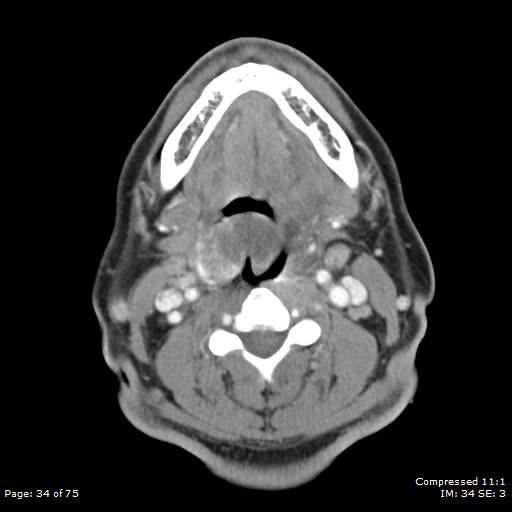 Acute epiglottitis (Radiopaedia 54375-60590 Axial C+ arterial phase 34).jpg