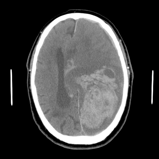 Acute hemorrhagic stroke (Radiopaedia 17507-17223 Axial non-contrast 32).jpg