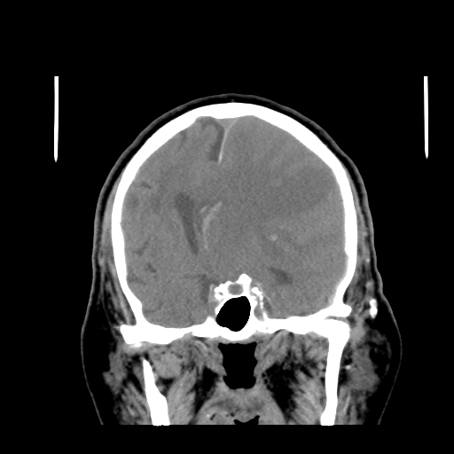 Acute hemorrhagic stroke (Radiopaedia 17507-17223 Coronal non-contrast 23).jpg