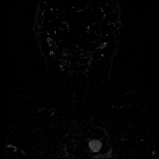 Acute internal carotid artery dissection (Radiopaedia 53541-59632 Coronal MRA 8).jpg