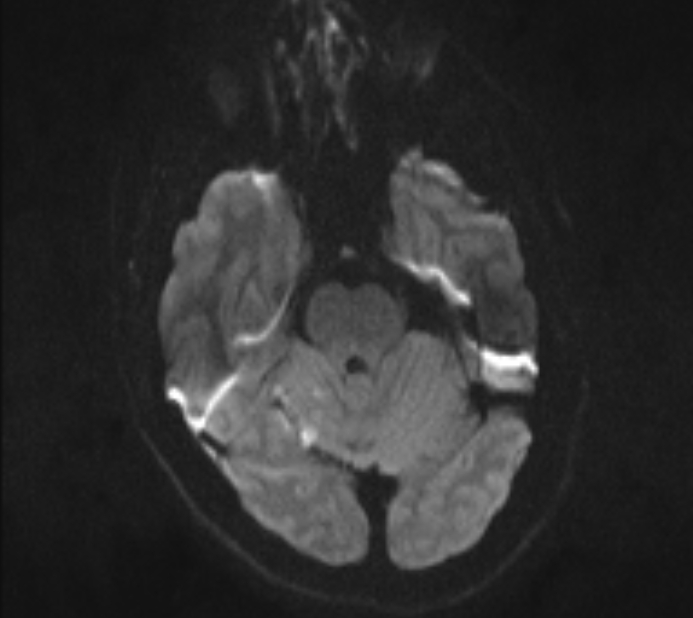 Acute ischemic stroke - posterior circulation territory (Radiopaedia 77670-89880 Axial DWI 31).jpg