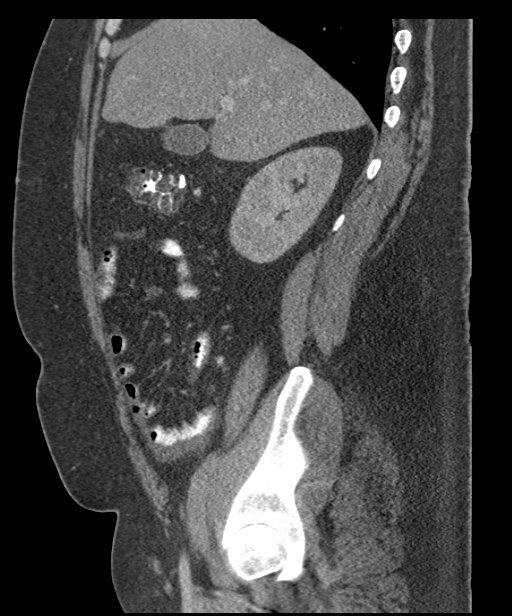 Acute mesenteric venous ischemia (Radiopaedia 46041-50383 Sagittal C+ portal venous phase 33).jpg
