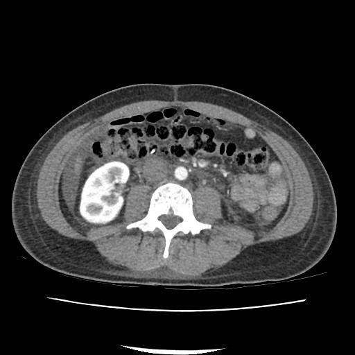 Acute myocarditis (Radiopaedia 55988-62613 Axial C+ portal venous phase 40).jpg