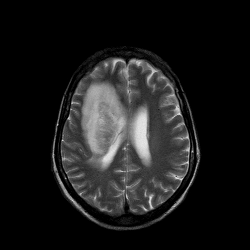File:Acute necrotizing toxoplasma encephalitis (Radiopaedia 10683-11149 Axial T2 6).jpg