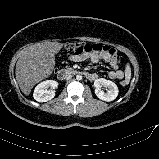 Acute on chronic pancreatitis (Radiopaedia 80902-94423 Axial C+ portal venous phase 79).jpg