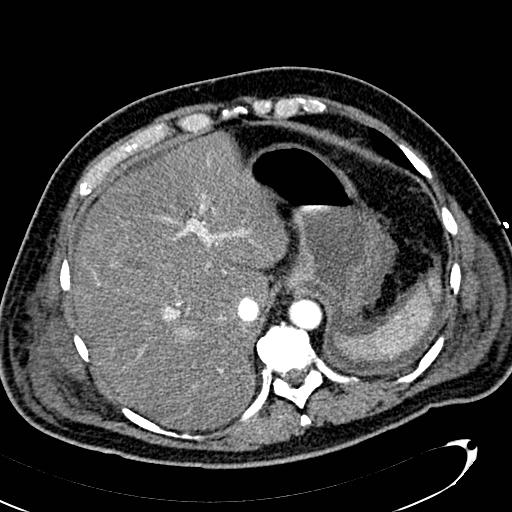 File:Acute pancreatic necrosis (Radiopaedia 13560-13486 Axial C+ portal venous phase 32).jpg