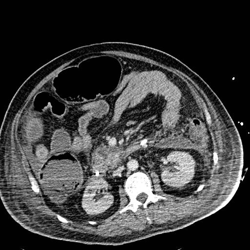 File:Acute pancreatic necrosis (Radiopaedia 13560-18501 Axial C+ portal venous phase 65).jpg