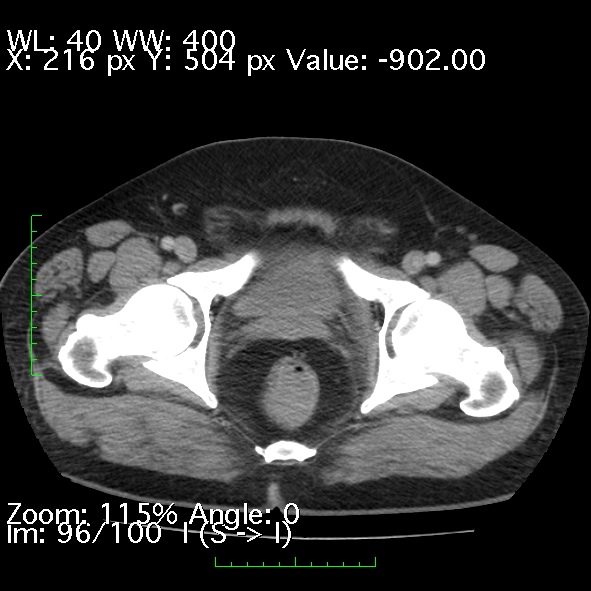 File:Acute pancreatitis (Radiopaedia 34043-35276 Axial C+ portal venous phase 96).jpg