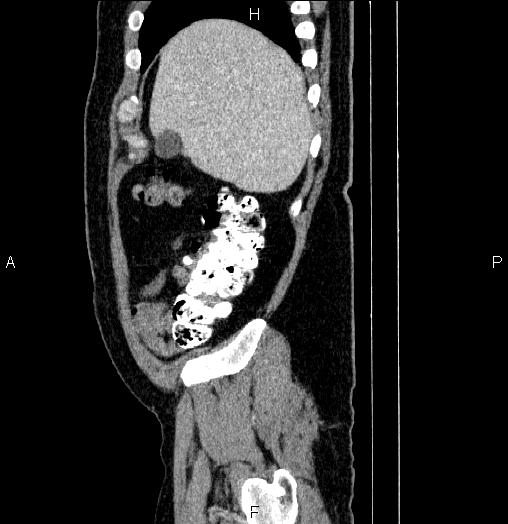 Acute pancreatitis (Radiopaedia 85390-101010 Sagittal C+ portal venous phase 11).jpg