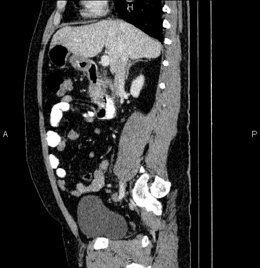 Acute pancreatitis (Radiopaedia 85390-101010 Sagittal C+ portal venous phase 38).jpg