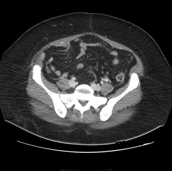 Acute pancreatitis - Balthazar E (Radiopaedia 29016-29377 Axial C+ portal venous phase 53).png