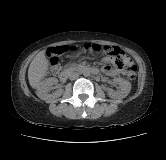 File:Acute pancreatitis - Balthazar E - post ERCP (Radiopaedia 27562-27772 Axial non-contrast 27).png