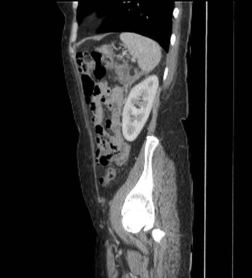 Acute pancreatitis - Balthazar E - post ERCP (Radiopaedia 27562-27772 Sagittal C+ portal venous phase 106).png