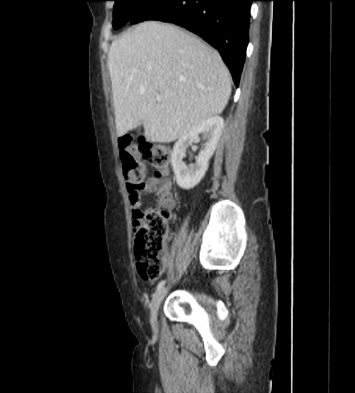 Acute pancreatitis - Balthazar E - post ERCP (Radiopaedia 27562-27772 Sagittal C+ portal venous phase 33).png