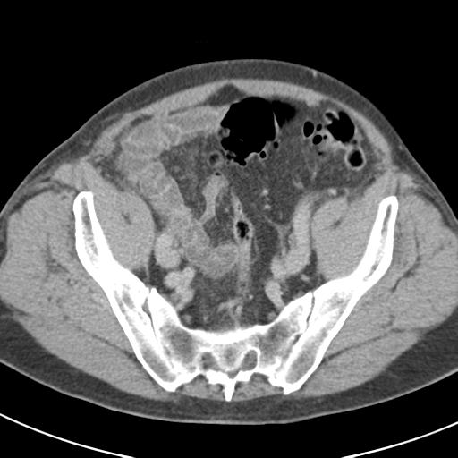 Acute pancreatitis and walled-off necrosis (Radiopaedia 29888-30403 Axial C+ delayed 68).jpg
