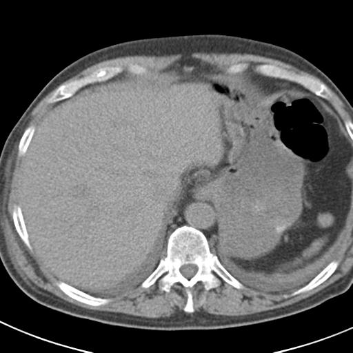 File:Acute pancreatitis and walled-off necrosis (Radiopaedia 29888-30403 Axial non-contrast 10).jpg