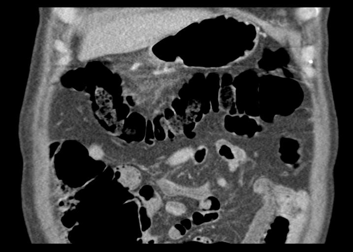 Acute pancreatitis and walled-off necrosis (Radiopaedia 29888-30403 Coronal C+ portal venous phase 15).jpg