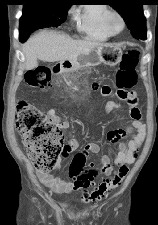 Acute pancreatitis and walled-off necrosis (Radiopaedia 29888-30403 E 18).jpg