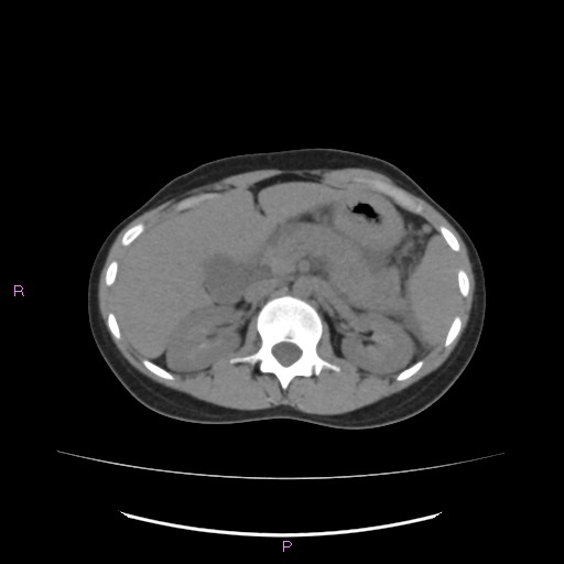 Acute pancreatitis secondary to stone at minor papilla and pancreatic divisum (Radiopaedia 76570-88333 Axial non-contrast 25).jpg