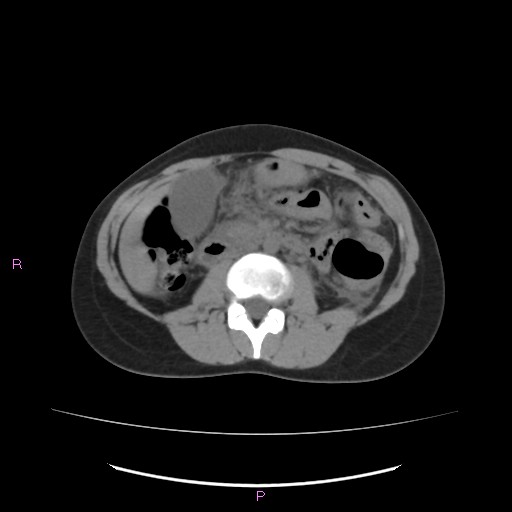 File:Acute pancreatitis secondary to stone at minor papilla and pancreatic divisum (Radiopaedia 76570-88333 Axial non-contrast 35).jpg
