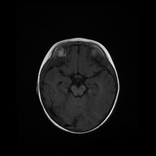File:Acute phase of hemiconvulsion-hemiplegia epilepsy syndrome (Radiopaedia 29309-29745 Axial T1 15).jpg